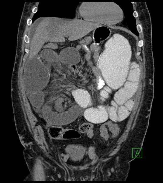 File:Closed-loop small bowel obstruction-internal hernia (Radiopaedia 78439-91096 Coronal non-contrast 36).jpg