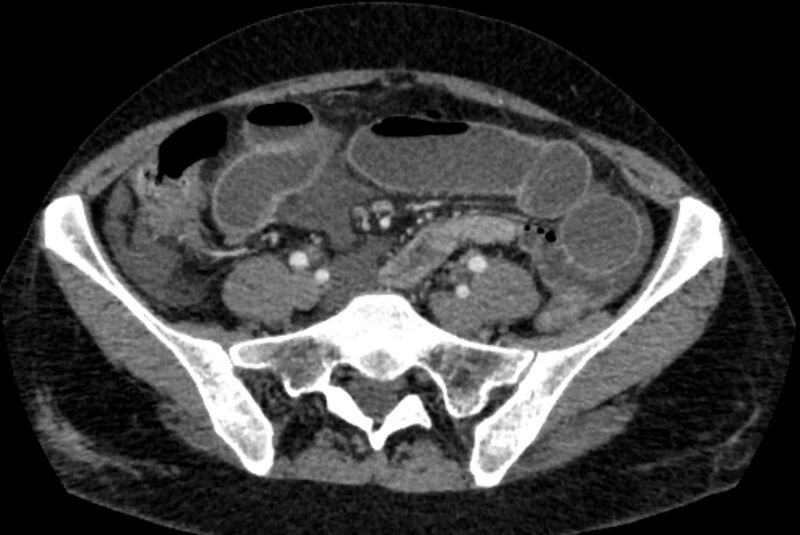 File:Closed loop small bowel obstruction (Radiopaedia 71211-81508 A 101).jpg