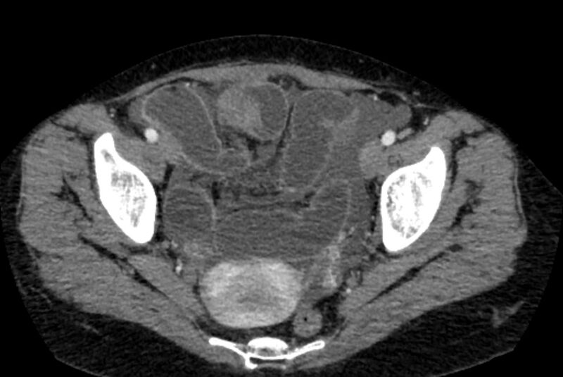 File:Closed loop small bowel obstruction (Radiopaedia 71211-81508 A 143).jpg