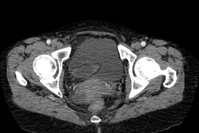 File:Closed loop small bowel obstruction (Radiopaedia 71211-81508 A 165).jpg