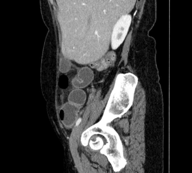 File:Closed loop small bowel obstruction (Radiopaedia 71211-81508 C 21).jpg