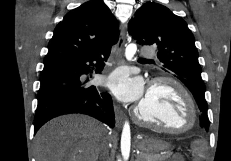 File:Coarctation of aorta with aortic valve stenosis (Radiopaedia 70463-80574 C 147).jpg