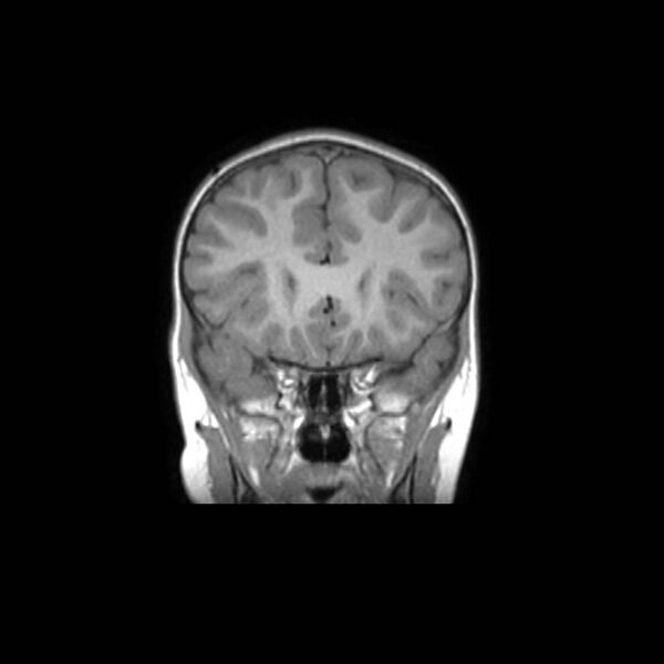File:Cochlear nerve aplasia - unilateral (Radiopaedia 87910-104413 Coronal T1 17).jpg