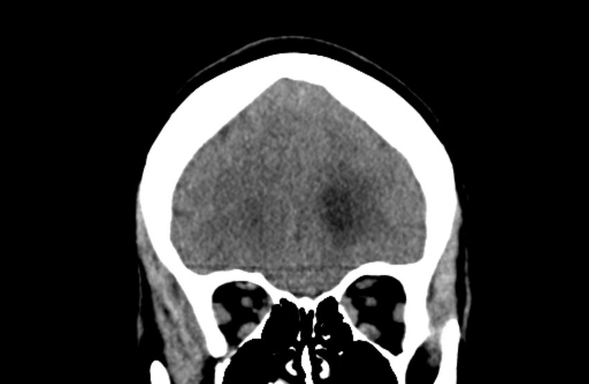 Colloid cyst (Radiopaedia 53180-59146 Coronal non-contrast 16).jpg