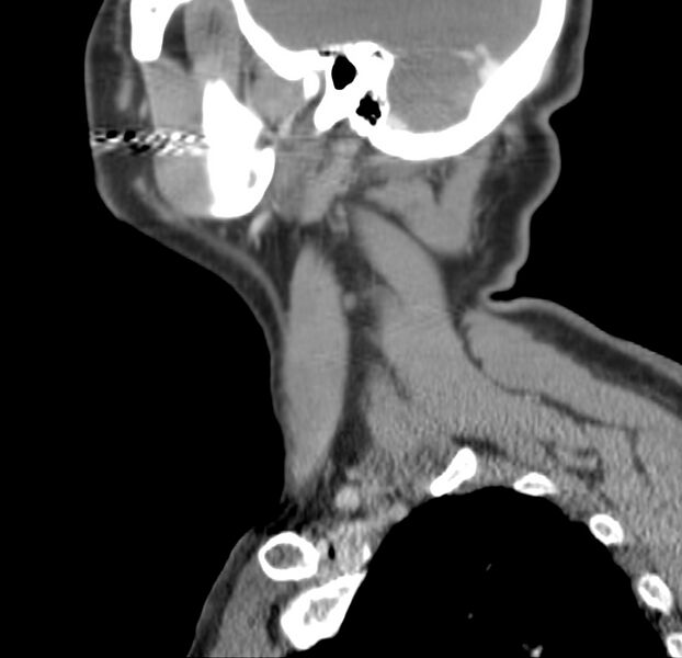 File:Colloid cyst of thyroid (Radiopaedia 22897-22923 Sagittal C+ delayed 46).jpg