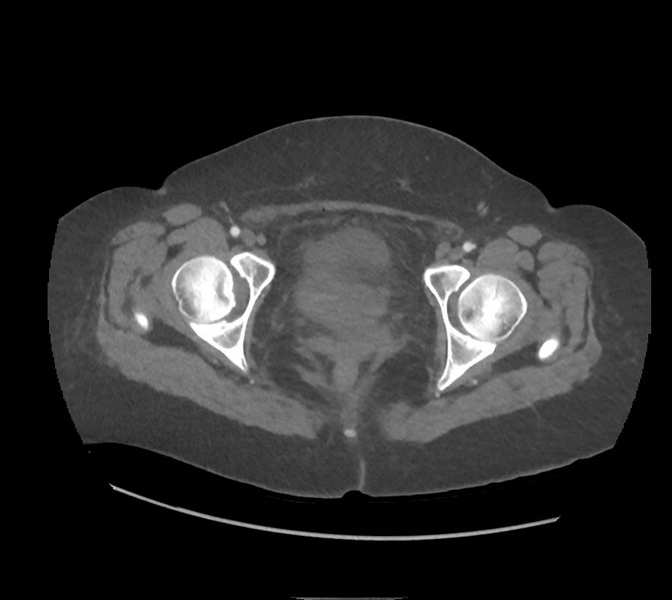 File:Colonic pseudo-obstruction (Radiopaedia 79752-92980 A 180).png