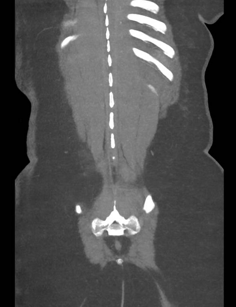 File:Colonic pseudo-obstruction (Radiopaedia 79752-92980 B 52).png