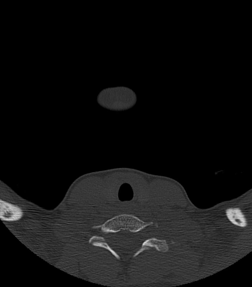 Nasoorbitoethmoid fracture (Radiopaedia 90044-107205 Axial bone window 3).jpg
