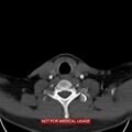 Nasopharyngeal carcinoma recurrence - skull base destruction (Radiopaedia 29107-29491 A 30).jpg