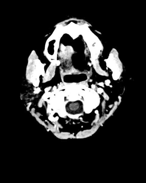 File:Nasopharyngeal carcinoma with cerebral abscess (Radiopaedia 43018-46275 Axial C+ delayed 3).png