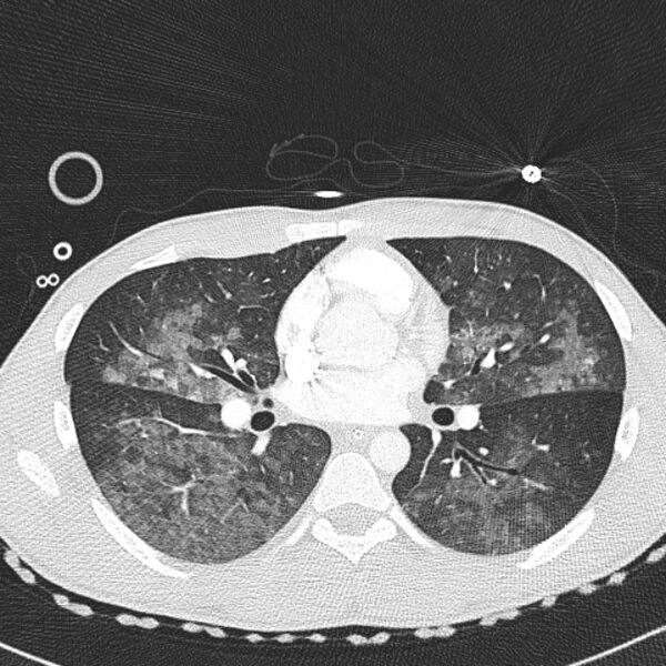 File:Near drowning (pulmonary edema) (Radiopaedia 24685-24958 lung window 31).jpg