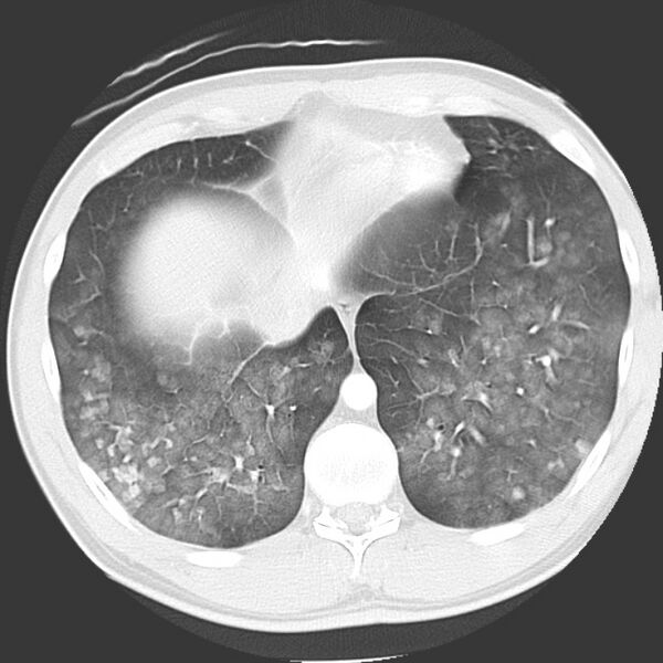 File:Near drowning pulmonary edema (Radiopaedia 16868-16591 Axial lung window 42).jpg