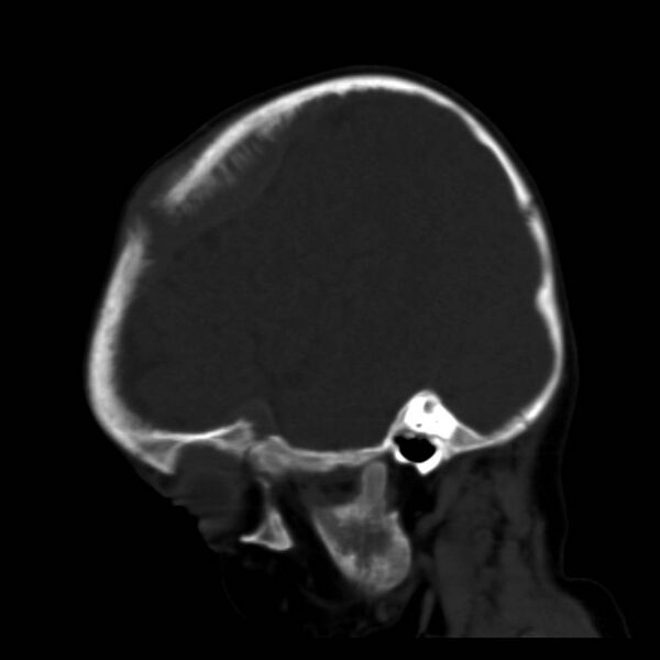 File:Neuroblastoma with skull metastases (Radiopaedia 30326-30958 Sagittal bone window 10).jpg