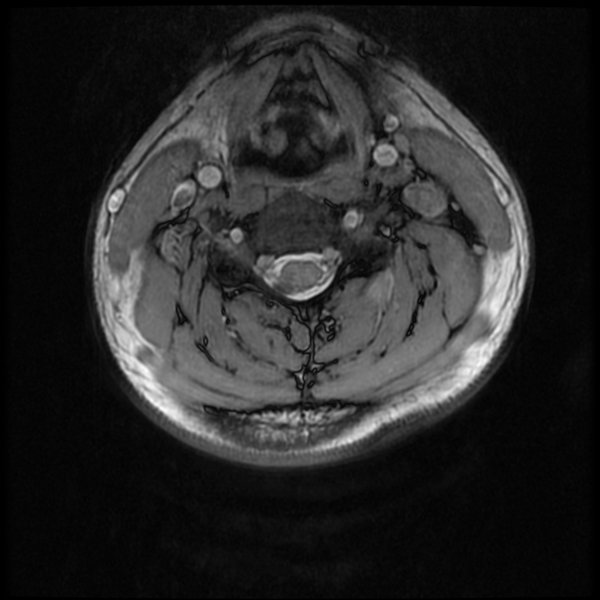 File:Neurofibromatosis type 2 (Radiopaedia 44936-48837 Axial Gradient Echo 22).png