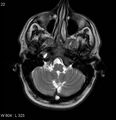 Neurosarcoidosis (Radiopaedia 10930-17204 Axial T2 3).jpg