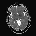 Neurotoxoplasmosis - concentric target sign (Radiopaedia 70644-80784 Axial ADC 10).jpg