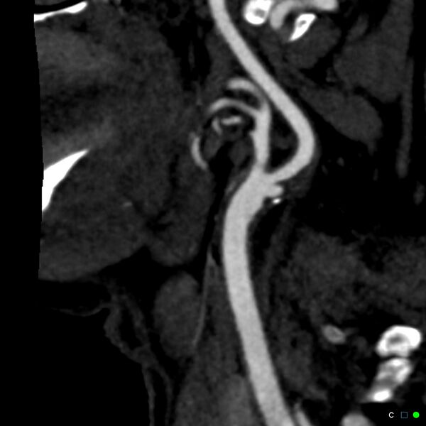 File:Non-occlusive intraluminal internal carotid artery thrombus (Radiopaedia 37751-39658 C 58).jpg