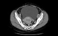 Non-puerperal uterine inversion (Radiopaedia 78343-91094 A 16).jpg
