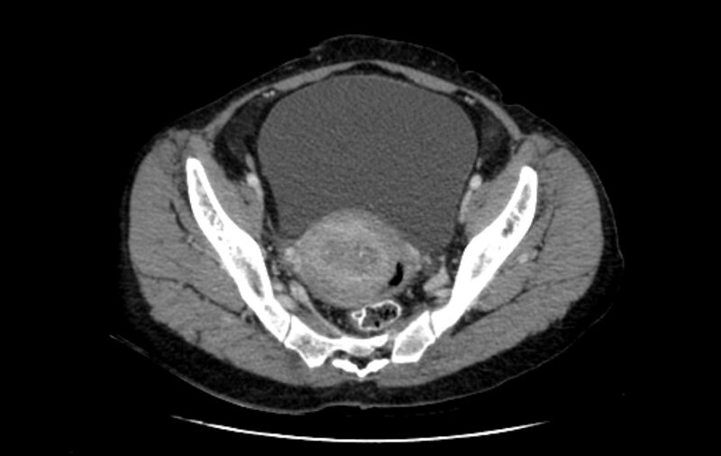 File:Non-puerperal uterine inversion (Radiopaedia 78343-91094 A 16).jpg