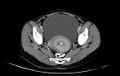 Non-puerperal uterine inversion (Radiopaedia 78343-91094 A 30).jpg