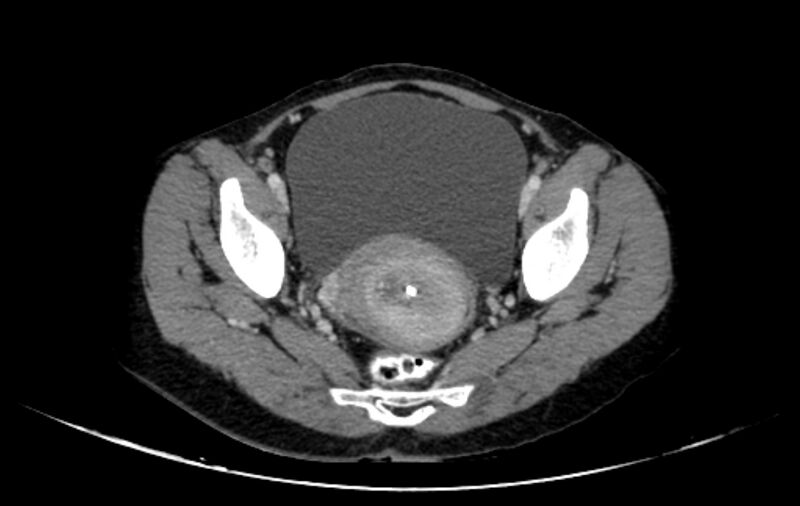 File:Non-puerperal uterine inversion (Radiopaedia 78343-91094 A 30).jpg