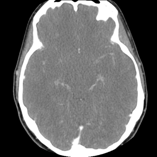 File:Normal CT of the neck (Radiopaedia 14575-14500 Axial C+ 1).jpg