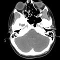 Normal CT of the neck (Radiopaedia 14575-14500 Axial C+ 11).jpg