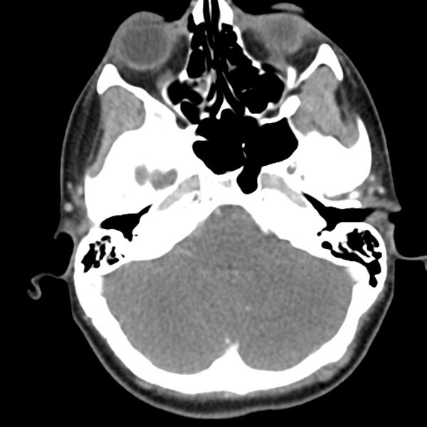 File:Normal CT of the neck (Radiopaedia 14575-14500 Axial C+ 11).jpg