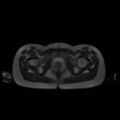 Normal MRI abdomen in pregnancy (Radiopaedia 88001-104541 Axial T2 70).jpg
