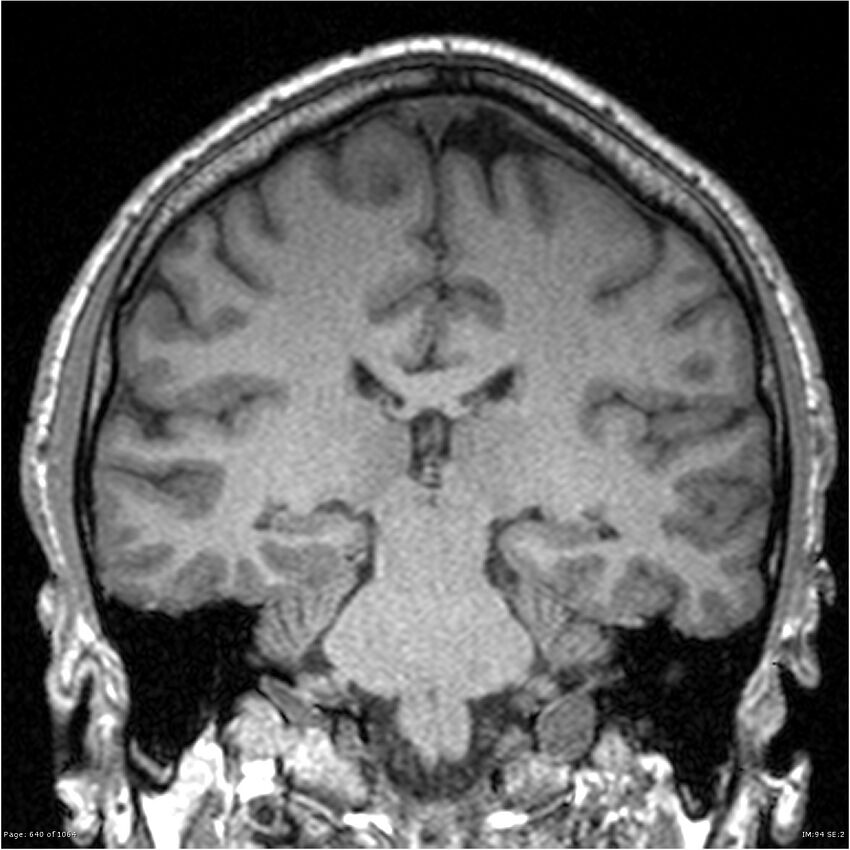 Normal brain MRI (non-focal epilepsy protocol) (Radiopaedia 38571-40700 Coronal T1 46).jpg