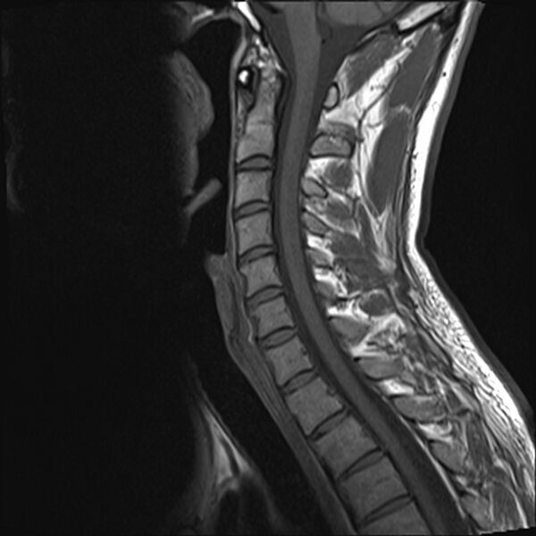 File:Normal cervical spine MRI (Radiopaedia 38418-40496 Sagittal T1 7).jpg