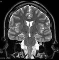 Normal coronal brain (Radiopaedia 6676-7910 Coronal T2 22).jpg
