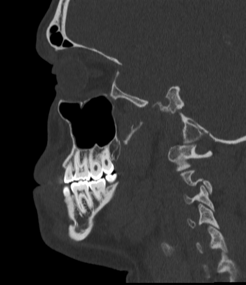 Normal facial bone CT (Radiopaedia 88742-105476 Sagittal bone window 111).jpg