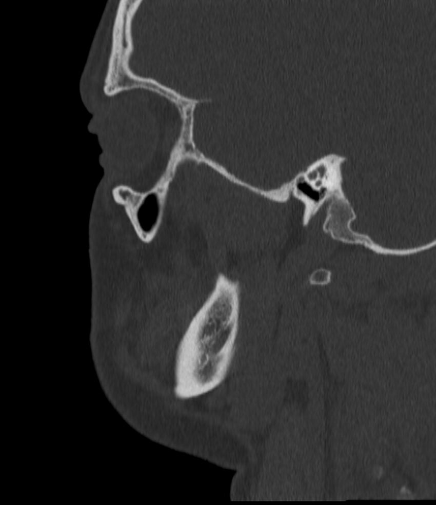 Normal facial bone CT (Radiopaedia 88742-105476 Sagittal bone window 124).jpg