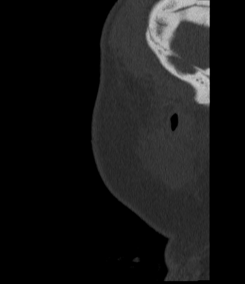 Normal facial bone CT (Radiopaedia 88742-105476 Sagittal bone window 155).jpg
