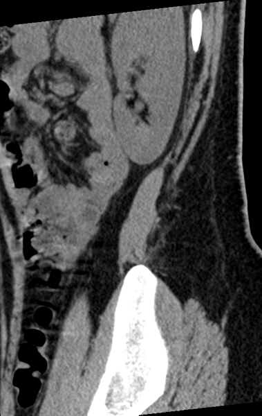 File:Normal lumbar spine CT (Radiopaedia 46533-50986 C 3).png