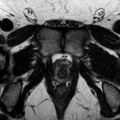 Normal prostate (MRI) (Radiopaedia 29986-30535 Axial T2 3).jpg