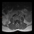 Normal spine MRI (Radiopaedia 77323-89408 Axial T1 2).jpg