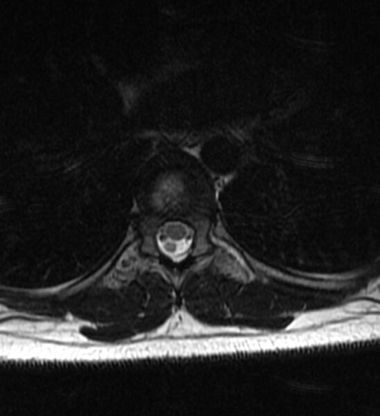File:Normal thoracic spine MRI (Radiopaedia 41033-43781 Axial T2 3).jpg
