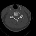 Occipital condyle fracture (Radiopaedia 31755-32691 Axial bone window 43).jpg