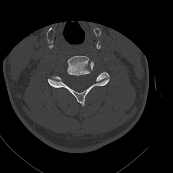 File:Occipital condyle fracture (Radiopaedia 31755-32691 Axial bone window 43).jpg