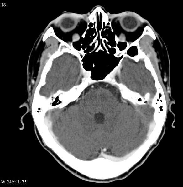 File:Occipital condyle metastasis - into mastoid (Radiopaedia 5424-7177 B 13).jpg