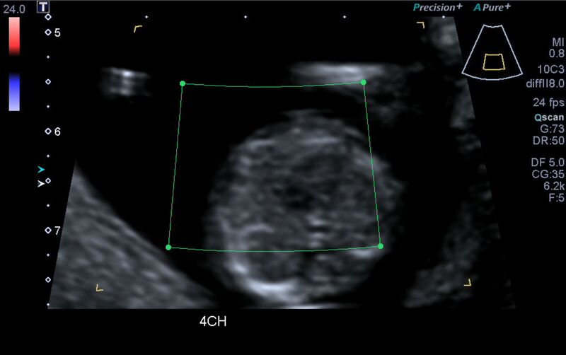 File:1st trimester nuchal-morphology ultrasound (Radiopaedia 44706-48477 Heart views cine with colour 26).jpg