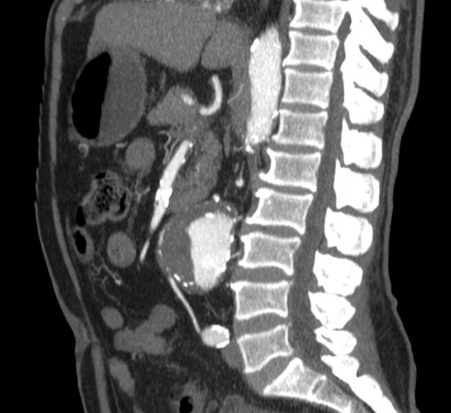 File:Abdominal aortic aneurysm (Radiopaedia 22421-22458 D 20).jpg