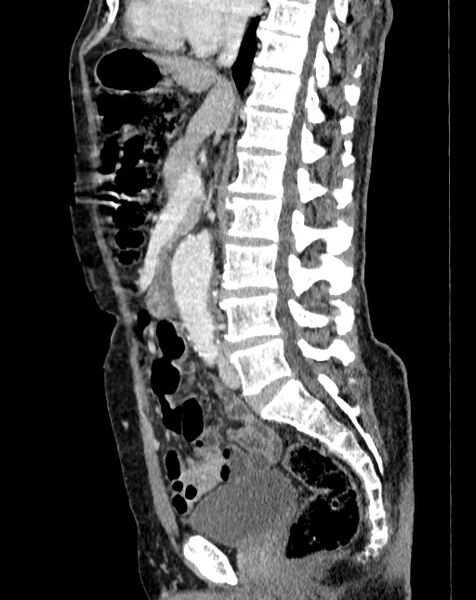 File:Abdominal aortic aneurysm (Radiopaedia 83581-98689 Sagittal C+ portal venous phase 45).jpg