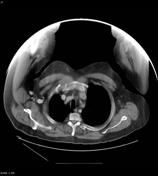 File:Abdominal aortic aneurysm with intramural hematoma then rupture (Radiopaedia 50278-55631 Axial C+ arterial phase 8).jpg