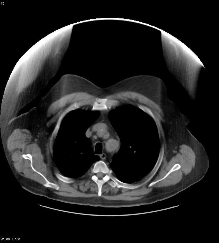 Abdominal aortic aneurysm with intramural hematoma then rupture (Radiopaedia 50278-55631 Axial non-contrast 11).jpg
