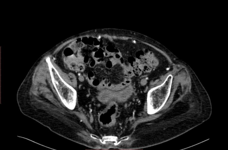 File:Abdominal aortic interposition tube graft and aneurysm thrombosis (Radiopaedia 71438-81857 Axial C+ arterial phase 198).jpg