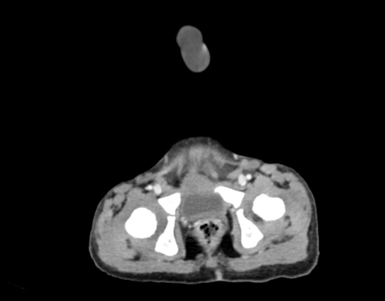File:Abdominal premesenteric cystic lymphangioma (Radiopaedia 82995-97350 Axial C+ portal venous phase 66).jpg