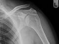 Acromioclavicular joint injury (type III) (Radiopaedia 35984).jpg